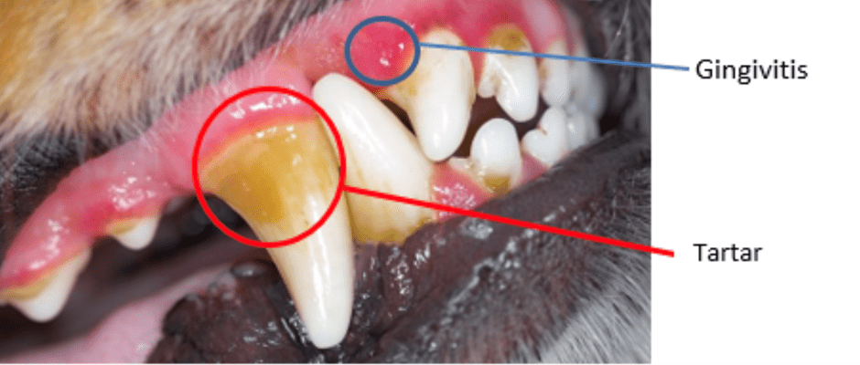 gingivitis tartar comparison